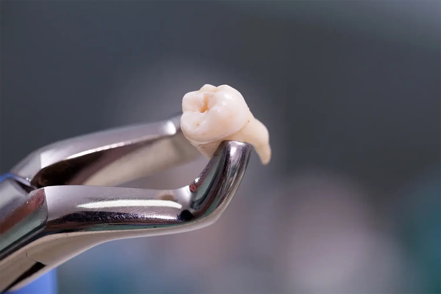Emergency Extraction: When a Painful Tooth Must Be Pulled Same-Day