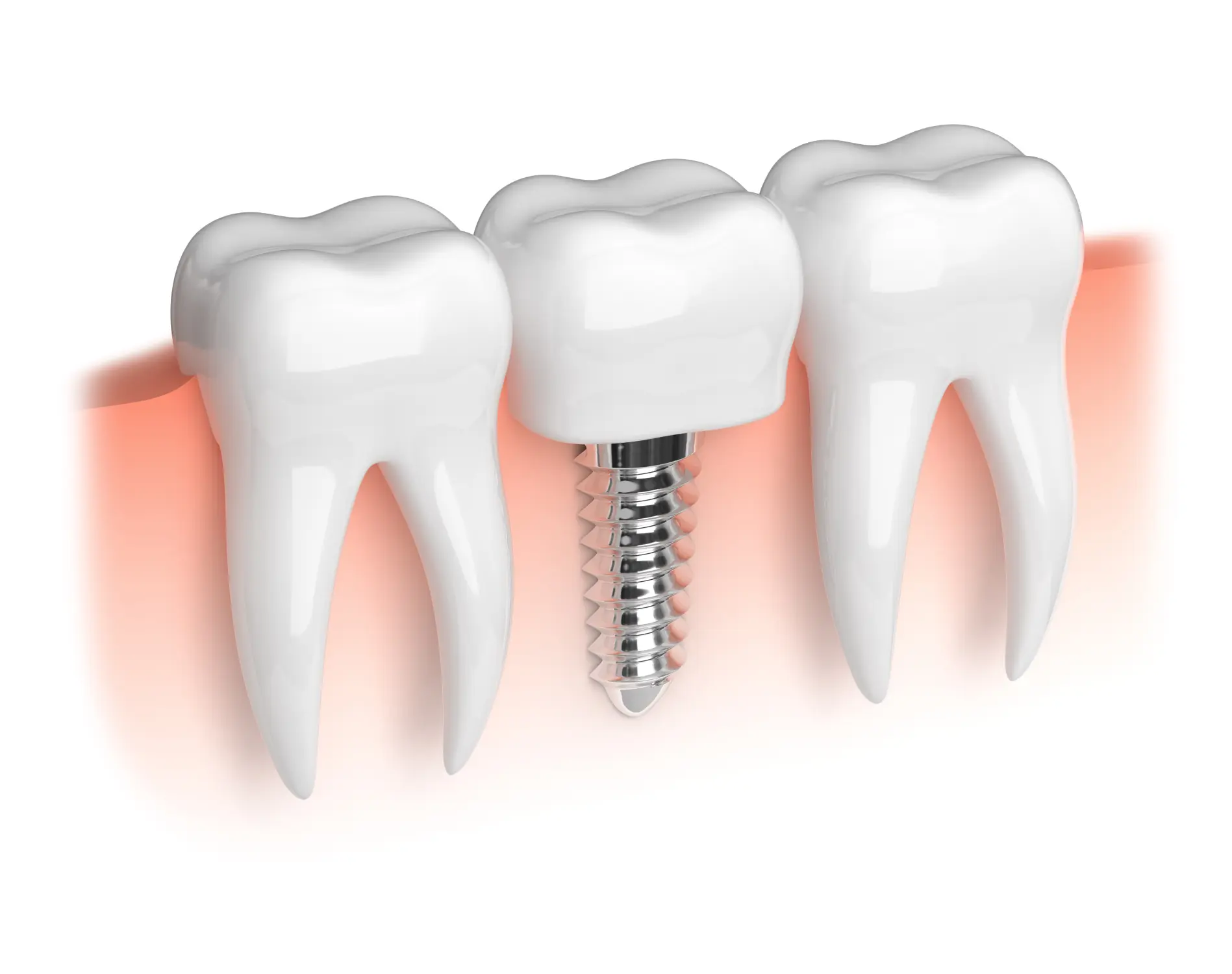 Dental Implants vs. Dentures vs. Bridges: Which Is Right for You?
