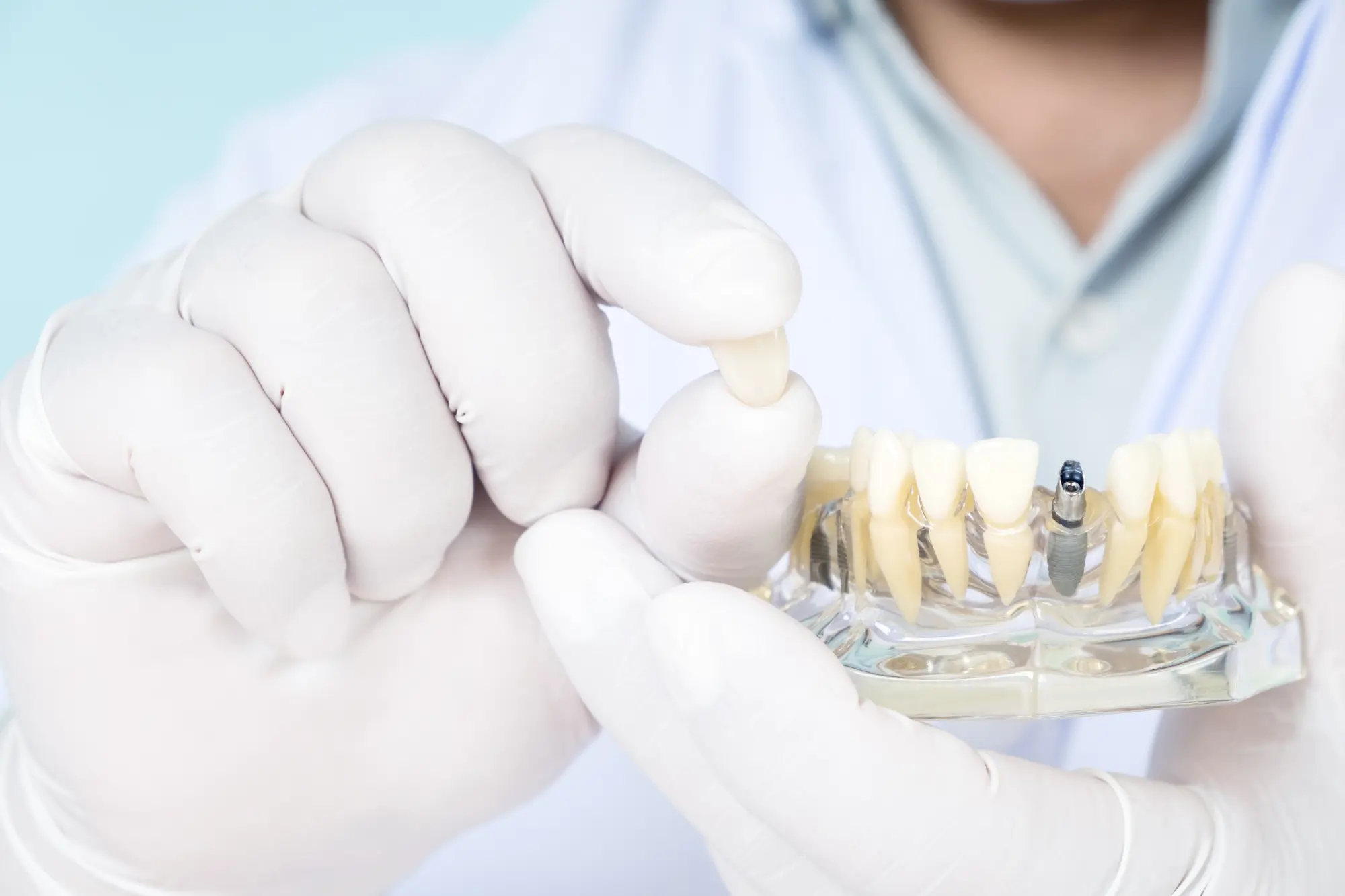 5 Signs You Might Be a Good Candidate for Dental Implants in Torrance